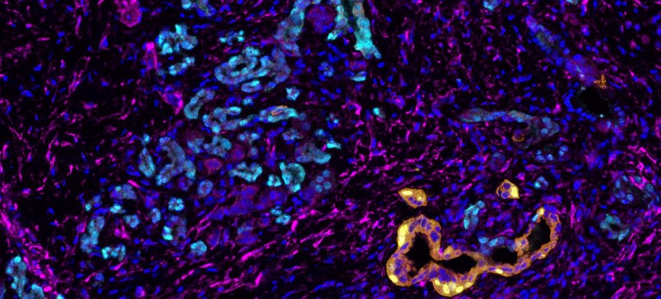 Mutlicolor imaging of patient PDAC tumor samples reveals subtype-specific markers for biomarker discovery